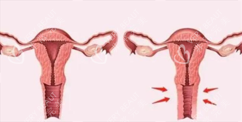 3D生物束带紧缩术对比图 3D生物束带紧缩术对比图