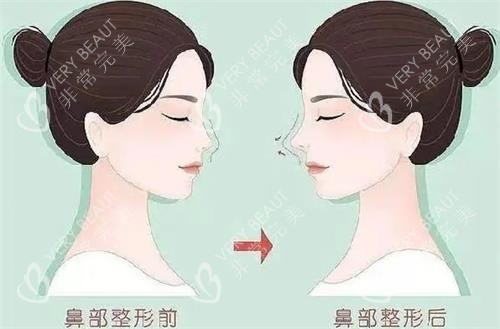 液态隆鼻前后的区别