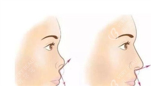 隆鼻前后对比示图