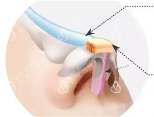 隆鼻假体植入鼻背动画展示图