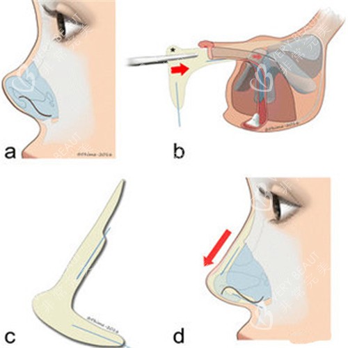 隆鼻过程图展示