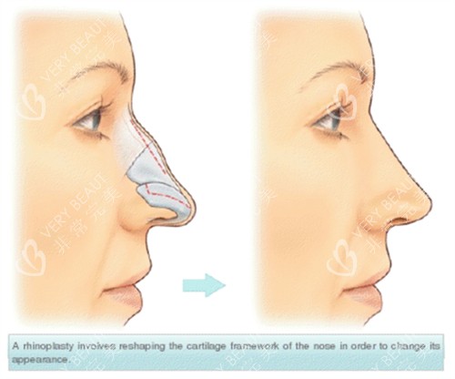隆鼻手术假体隆鼻