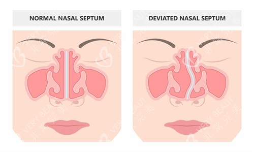 鼻修复手术前后对比 鼻修复手术前后对比