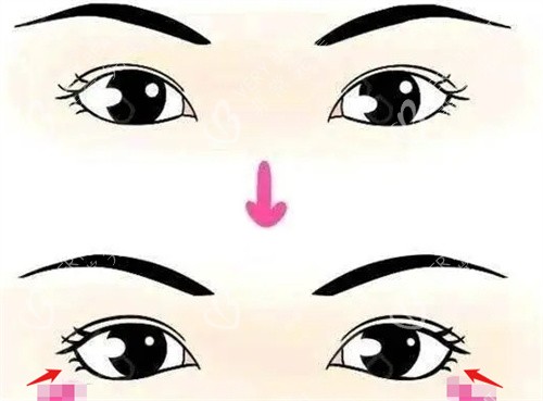 眼睑下至前后对比图.jpg