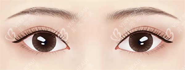 上眼睑松弛矫正