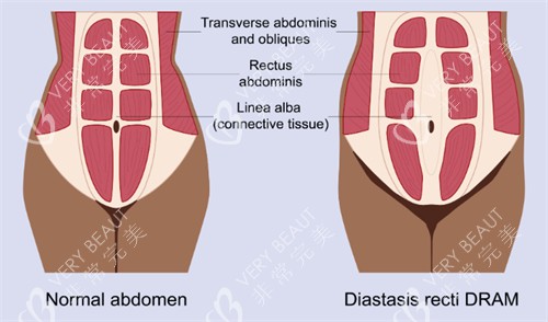 腹壁成形改善腹直肌