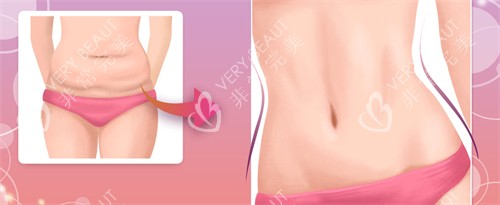 腹壁成形手术前后对比图