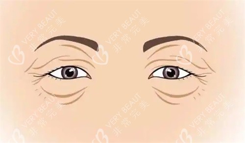 衰老的双眼皮 衰老的双眼皮
