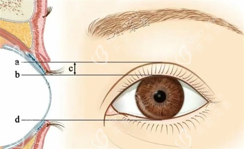PARK法双眼皮素材 PARK法双眼皮素材