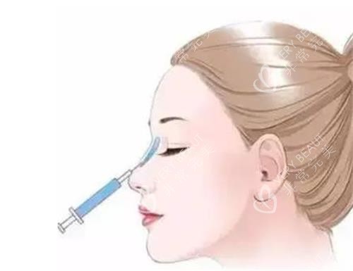 液态隆鼻的部位 液态隆鼻的部位