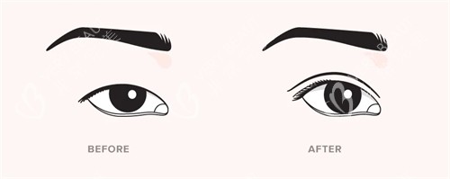 双眼皮手术前后对比 双眼皮手术前后对比