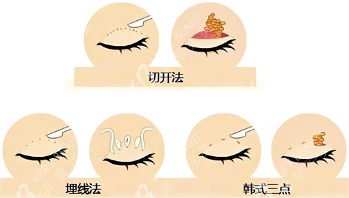 双眼皮方法对比图 双眼皮方法对比图