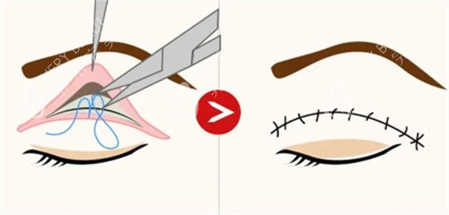 埋线双眼皮过程 埋线双眼皮过程