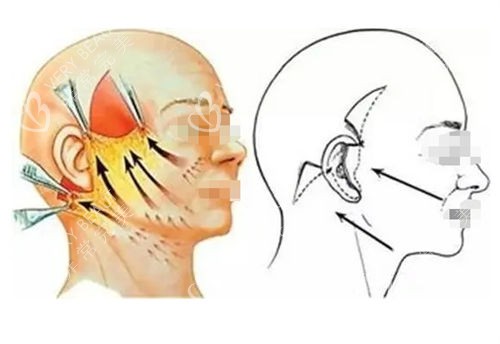 拉皮手术前后提拉对比图 拉皮手术前后提拉对比图