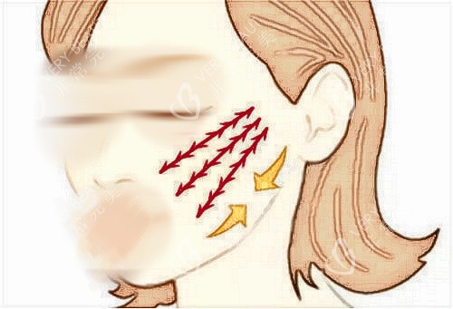 拉皮手术面部提拉示意图.jpg 拉皮手术面部提拉示意图.jpg