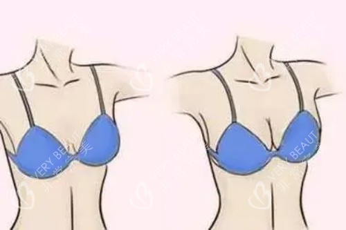 假体丰胸卡通对比图 假体丰胸卡通对比图