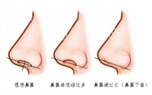 鼻翼退缩矫正术图片实例