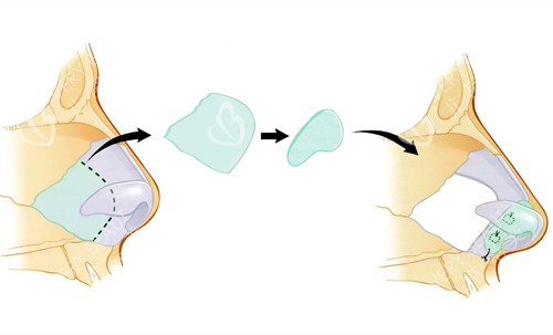 假体隆鼻简易过程示意图 假体隆鼻简易过程示意图