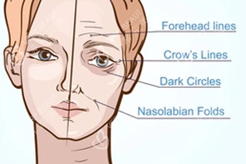 人体衰老形成的不同皱纹 人体衰老形成的不同皱纹