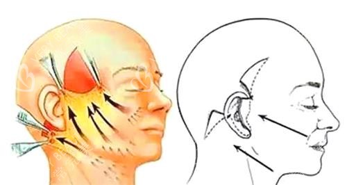 拉皮手术图 拉皮手术图
