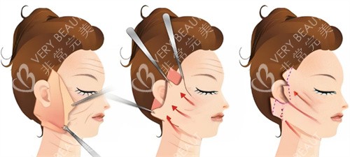 拉皮手术过程图 拉皮手术过程图