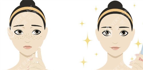 激光祛斑对比示图 激光祛斑对比示图