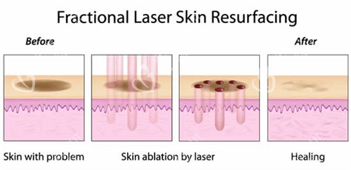 激光祛斑流程图 激光祛斑流程图