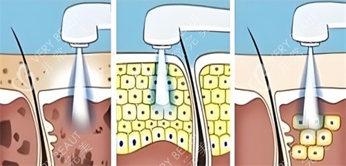 皮秒祛斑 皮秒祛斑