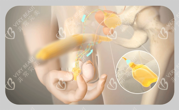 男性阴茎假体植入三件套手术过程 男性阴茎假体植入三件套手术过程