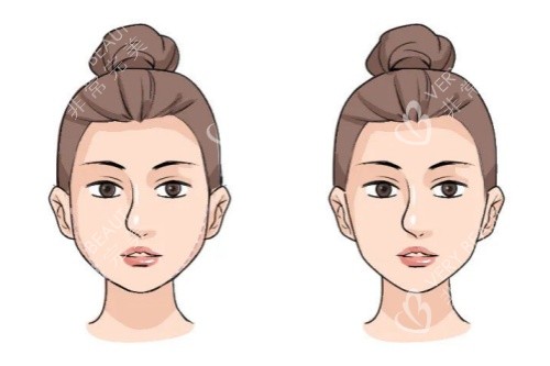 面部馒化修复卡通对比图