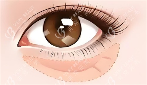 眼袋的位置卡通图