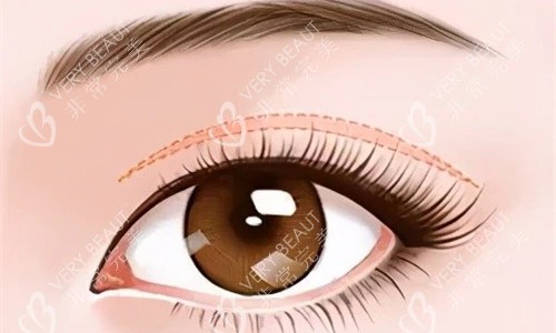 双眼皮特写展示图 双眼皮特写展示图