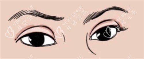 双眼皮肉条感 双眼皮肉条感