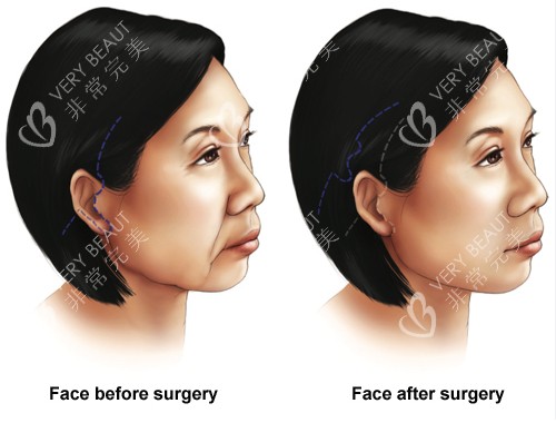 面部提升手术前后对比图 面部提升手术前后对比图