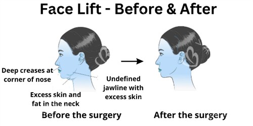 面部提升前后下巴及皮肤的改善对比 面部提升前后下巴及皮肤的改善对比