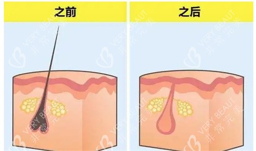脱毛前后的毛囊
