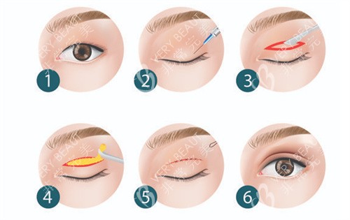 双眼皮全切手术过程