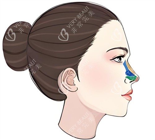 隆鼻修复图 隆鼻修复图