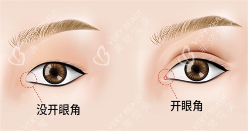 开眼角手术对比 开眼角手术对比