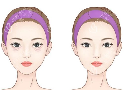 年轻祛眼袋前后对比 年轻祛眼袋前后对比