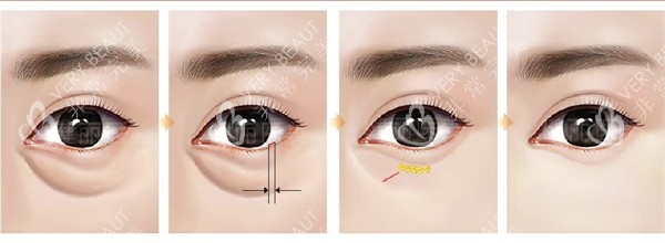 不开刀祛眼袋 不开刀祛眼袋