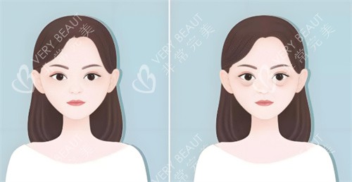 祛眼袋手术前后对比 祛眼袋手术前后对比