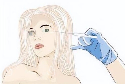 注射胶原蛋白去泪沟示意图