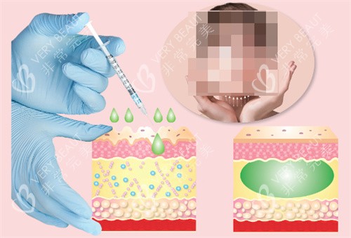 面部注射***