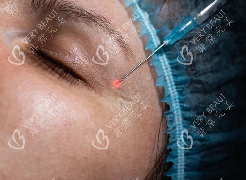 眼周玻尿酸注射