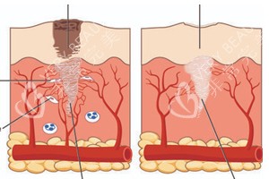 不同情况的疤痕在皮肤上的表现 不同情况的疤痕在皮肤上的表现