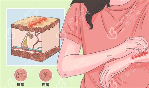 疤痕疙瘩的样子 疤痕疙瘩的样子