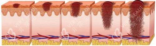 不同深度的疤痕 不同深度的疤痕