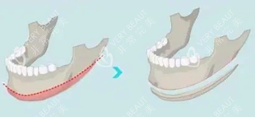 下颌角长曲线截骨前后对比 下颌角长曲线截骨前后对比