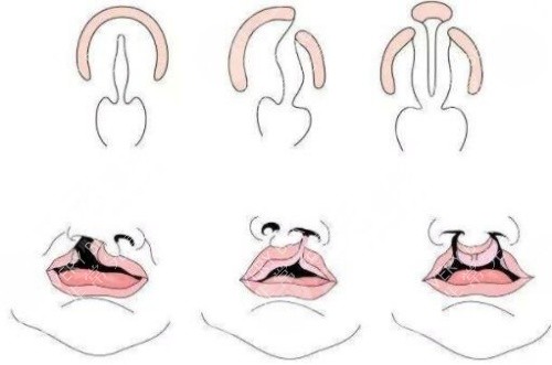 唇裂鼻修复结构图